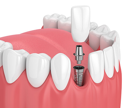 illustration of a single tooth implant
