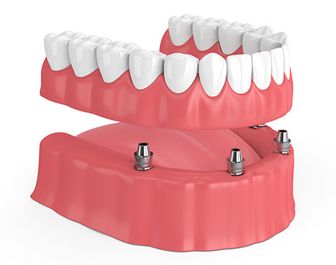 illustration of an All-on-4 dental implant