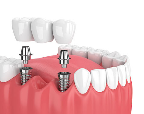illustration of an implant bridge